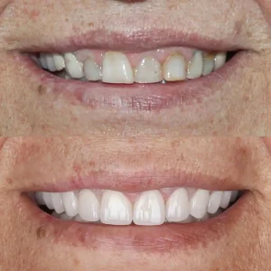 Lumina-Smile-Studio-Before-After-Image-Five-One