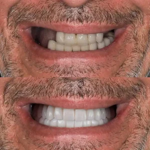 Lumina-Smile-Studio-Before-After-Image-Four-One