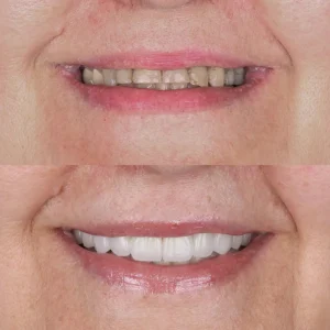 Lumina Smile Studio Before After Image One