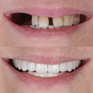 Lumina-Smile-Studio-Before-After-Image-Six-One