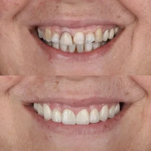 Lumina Smile Studio Before After Image Three