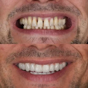 Lumina Smile Studio Before After Image Two